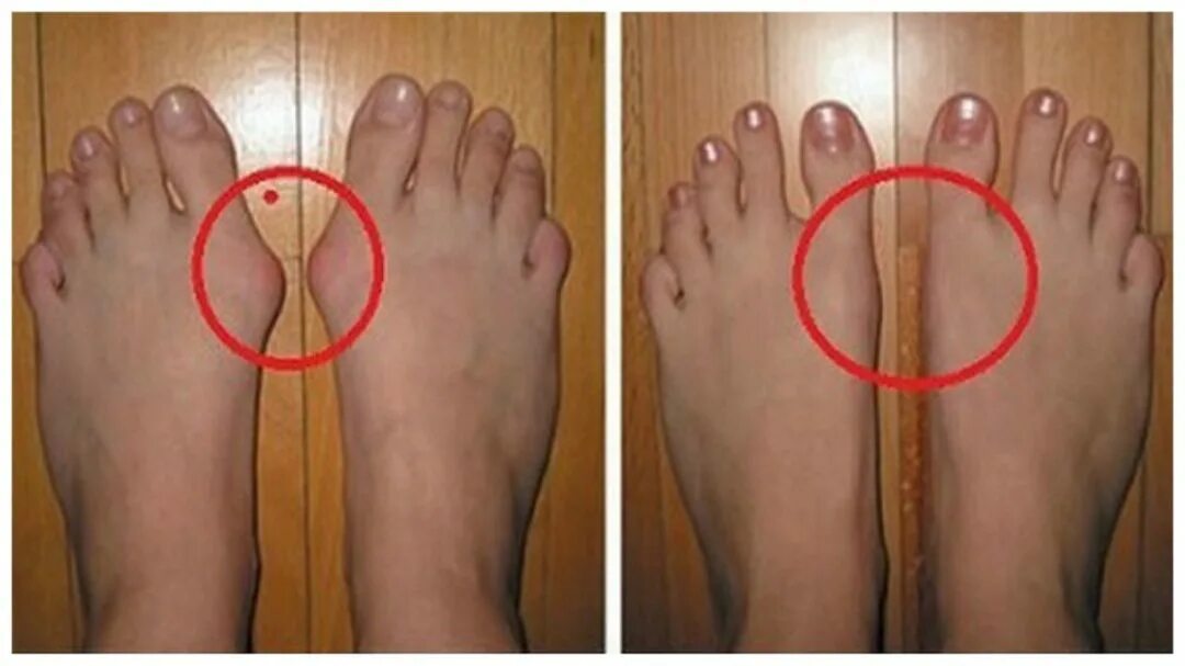 Уменьшение стопы. Уменьшение стопы. Упражнения для поднятия свода стопы. Уменьшение стопы. Халюкс вальгус у знаменитостей.