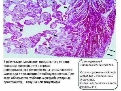 Некомпактный миокард
