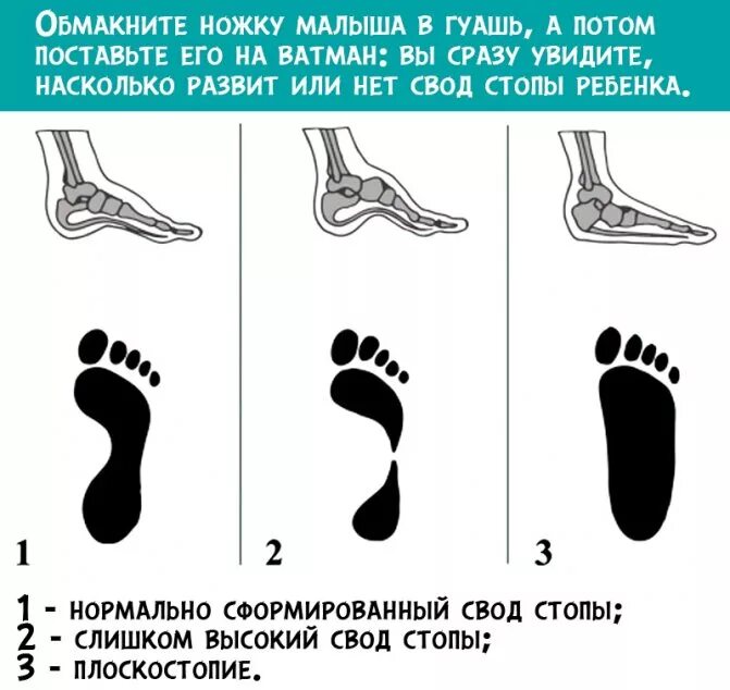 Чем может быть вызвано плоскостопие у человека. Плоскостопие 6 степени. Плоскостопие 1, 2, 3 степени. Плоскостопие 3 степени симптомы у подростков.