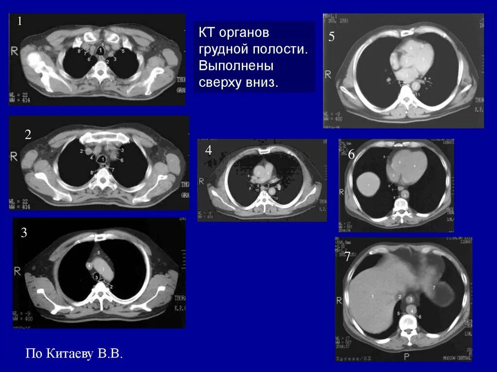 Кт органов грудной полости. Компьютерная томография грудной полости. Кт органов грудной полости анатомия. Рентгеновская компьютерная томография грудной полости. Кт органов брюшной полости грудной клетки