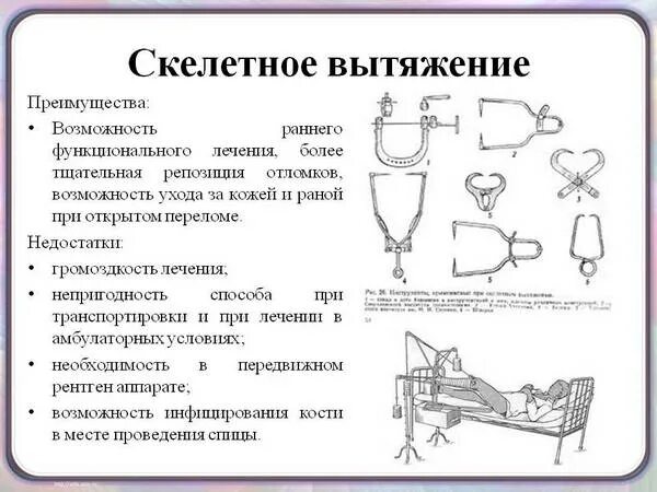 Схема скелетного вытяжения при переломе вертельной зоны бедра. Методика скелетного вытяжения при переломе бедренной кости. Набор инструментов для скелетного вытяжения алгоритм. Лечение переломов методом скелетного вытяжения. Этапы лечения переломов