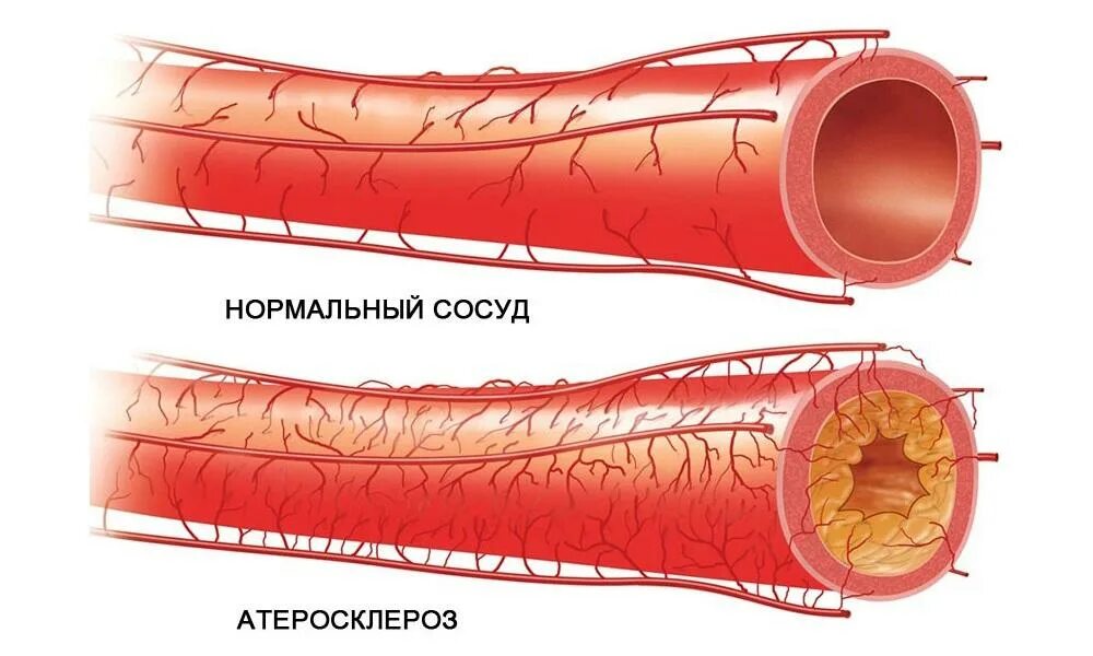 Атеросклеротическое поражение коронарных сосудов. Атеросклероз аорты и коронарных артерий. Атеросклероз коронарных артерий сосуды. Атеросклеротическая бляшка коронарного сосуда.