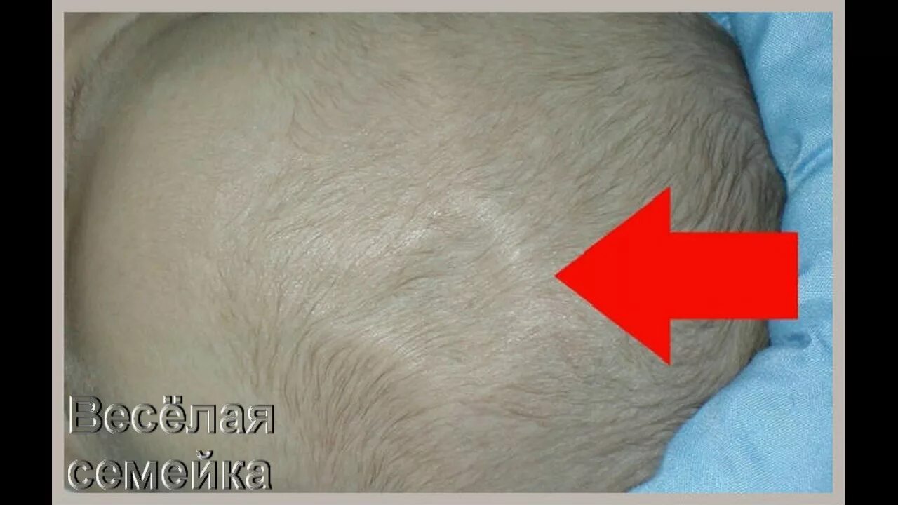 Впалый родничок у грудничка. Родничок у детей размеры. Родничок на голове у новорожденного что такое. Большой родничок рахит. Родничок на голове у новорожденного что такое.