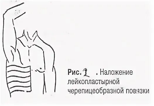 Повязка на ребра при переломе