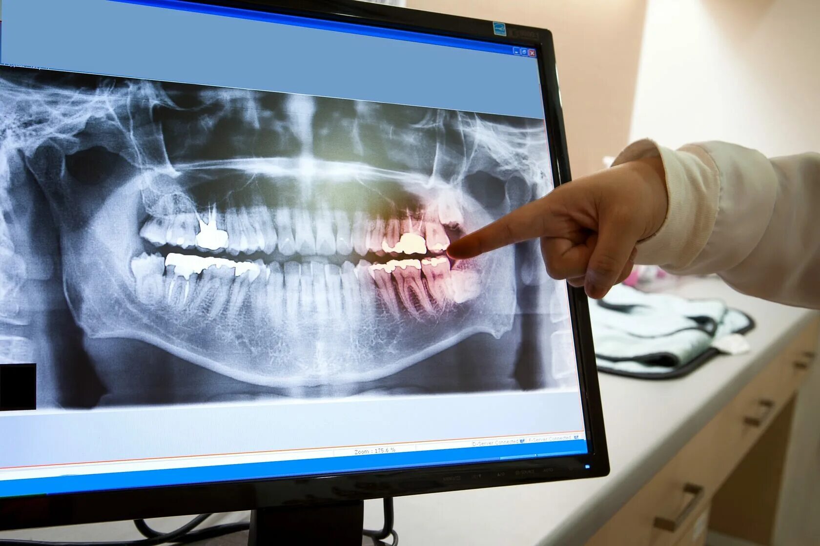 Где сделать кт зуба. Рентген зубов панорамный снимок Пикассо. Прицельная внутриротовая рентгенография. Рентген аппарат ОПТГ.
