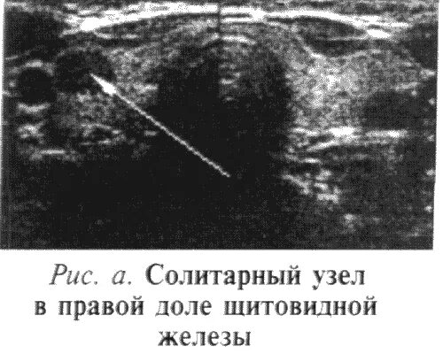 Узловые образования обеих долей щитовидной железы. Щитовидная железа УЗИ норма и узлы. Узел 1 см в щитовидной железе по УЗИ. УЗИ щитовидной железы узел правой доли. Доброкачественное новообразование щитовидной железы на УЗИ.