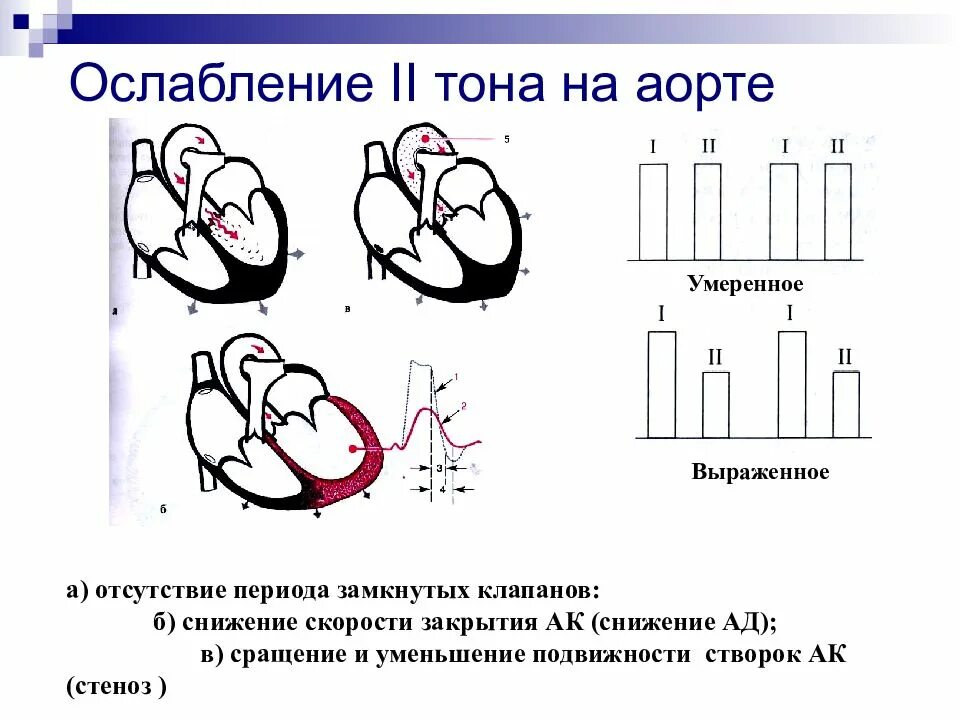 Ослабление тонов сердца в норме и при патологии.. Ослабление 2 тона над аортой. Ослабление второго тона на аорте. Ослабление 2 тона сердца. Ослабленные тоны сердца