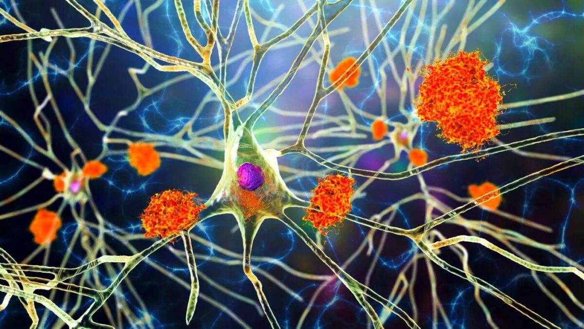 Новые клетки мозга. Амилоидные бляшки Альцгеймера. Болезнь Альцгеймера амилоидные бляшки. Амилоидные бляшки в головном мозге. Амилоидные бляшки и нейрофибриллярные клубки.