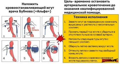 Гемостаз жгут