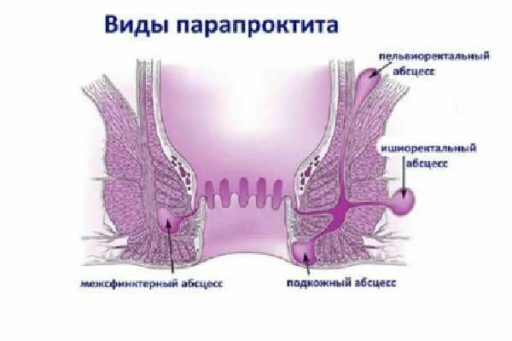 Ощущение в прямой кишке. Хронический парапроктит ишиоректальный. Пельвиоректальный парапроктит осложнения. Ишиоректальный парапроктит операция. Острый парапроктит свищ.