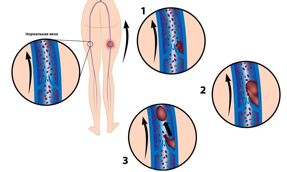 Тромбоз глубоких вен (ТГВ) – что это такое?. Поверхностный тромбофлебит, перифлебит;. Флеботромбоз глубоких вен нижних конечностей. Тромбоз вен нижних лекарства