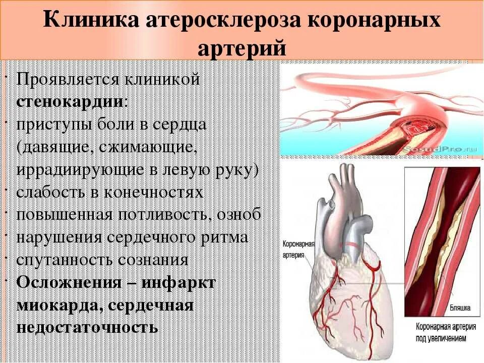 Сужение сосудов руки. Клинические проявления атеросклероза коронарных артерий. Ишемическая болезнь сердца атеросклероз коронарных артерий. Симптомы поражения коронарных артерий. Стеноз коронарных артерий симптомы.