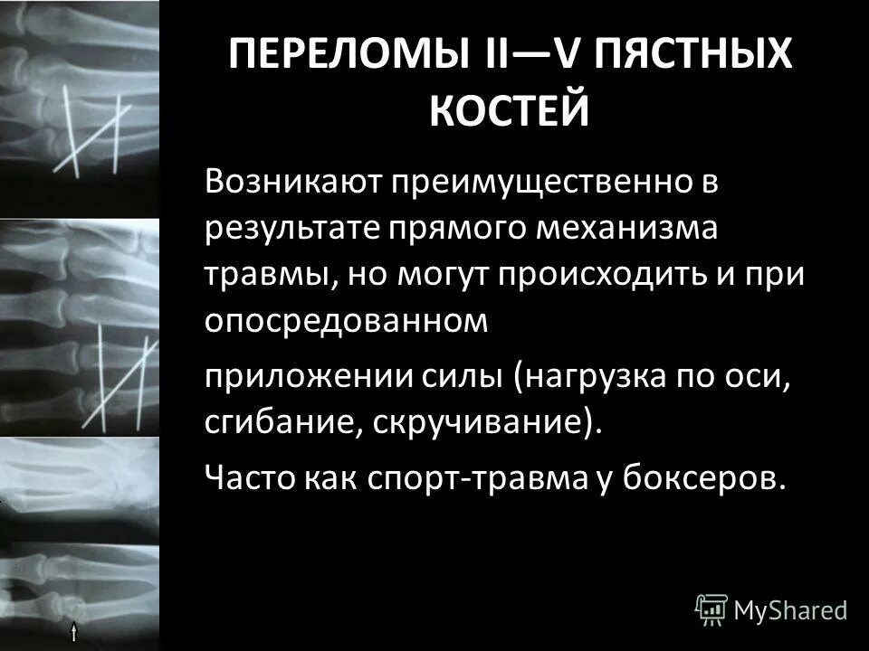 Перелом 5 пястной кости мкб 10. Крючковидная кость перелом. Перелом 5 пястной кости мкб 10. Рентген кисти перелом пястной кости. Перелом 5 пястной кости.
