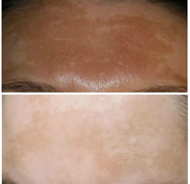 HyperPigmentationis the new Wrinkle! Visit our most recent Blog Post to find out