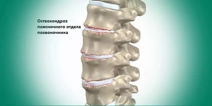 Дистрофические изменения позвоночника. Спондилоартроз л3-л5. Дегенеративно дистрофические изменения l3-l5. Остеохондроз 2 степени поясничного отдела позвоночника. Дегенеративно-дистрофические изменения шейного отдела.