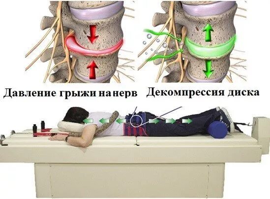 Грыжа позвоночника поясничного отдела операция. Аппараты для межпозвоночных грыж. Аппарат для грыжи позвоночника. Профилактика позвоночной грыжи. Грыжа межпозвоночного диска профилактика.