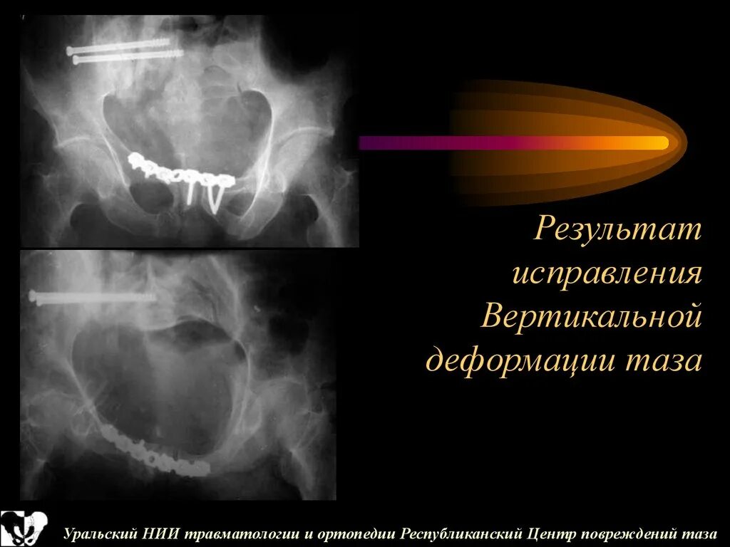 Коррекция деформации таза. Повреждения таза травматология презентация. Деформации в травматологии. Переломы костей таза травматология.