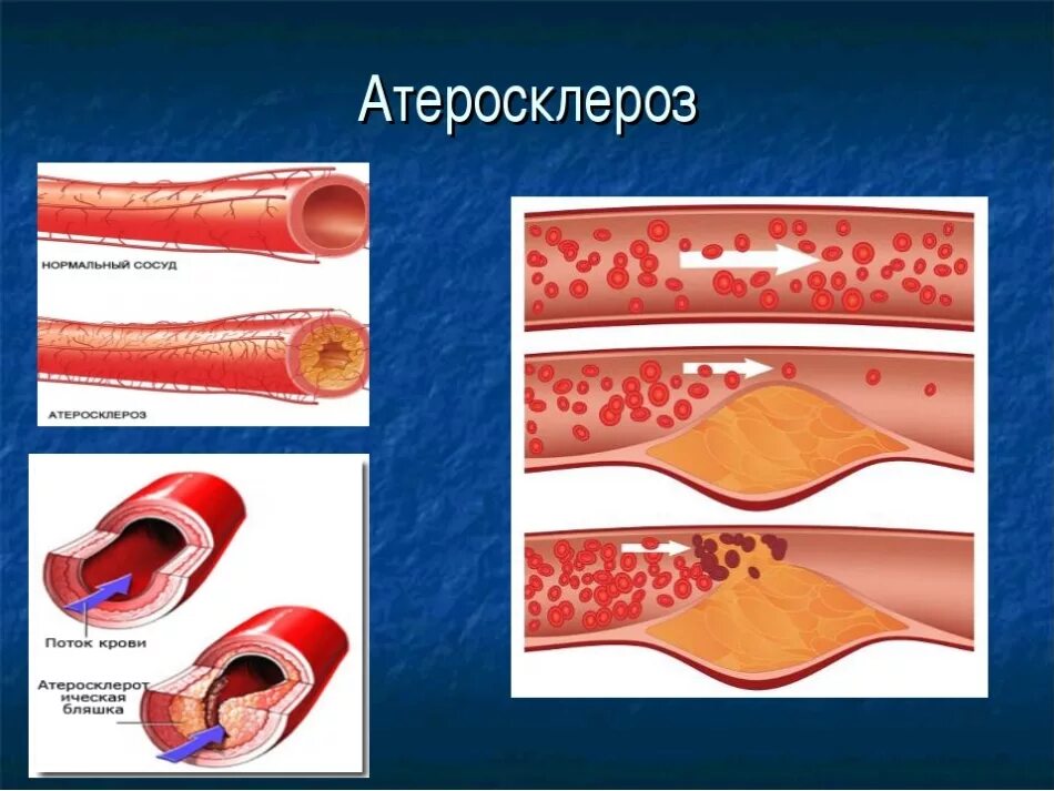 Заболевания артериальных сосудов. Атеросклеротическая бляшка. Атеросклеротическое поражение сосудов. Aterokskleroz.