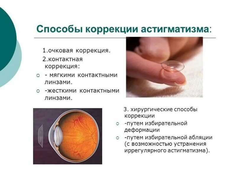 Как исправить астигматизм. Астигматизм (виды, принципы коррекции).. строение глаза астигматизм. методы коррекции астигматизма. способы устранения астигматизма.