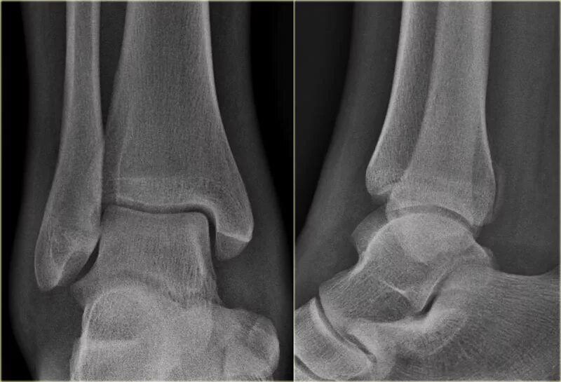 Fracture c