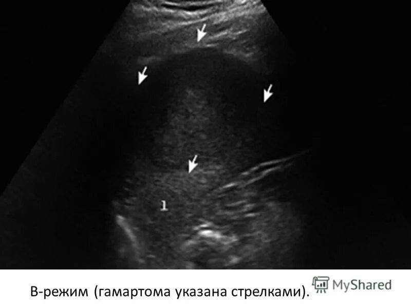 Гамартома печени. Гамартомы желчных протоков УЗИ. Гамартома селезенки на УЗИ. Билиарная гамартома УЗИ. Билиарная гамартома печени.