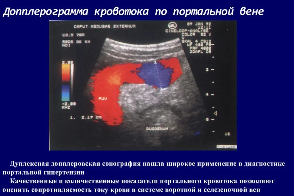 Синдром портальной гипертензии УЗИ. Кровлток гепатлпетальный воротная Вена. Допплерография при портальной гипертензии. Коллатеральный кровоток воротной вены. Печень расширены вены