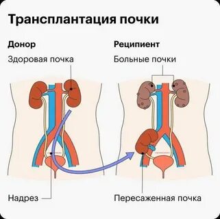 Почечный трансплантат