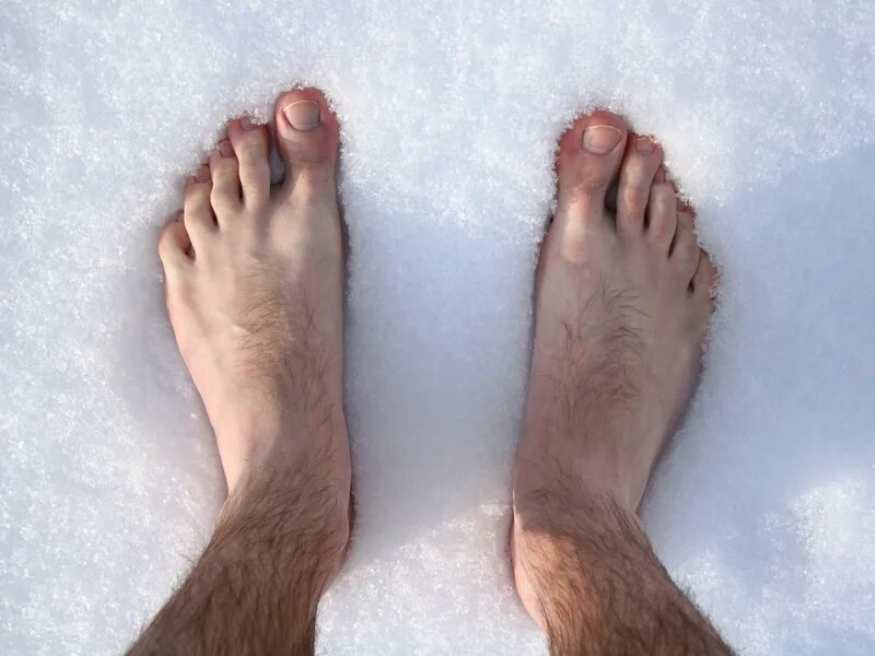 Обморожение конечностей. Отморожение пальцев ног.