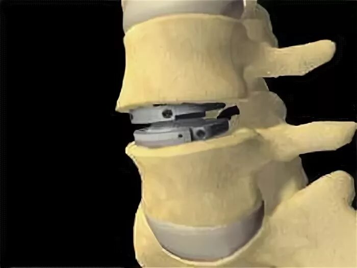 Операция замена дисков позвоночника. Кейдж имплант шейного отдела. Имплант межпозвонкового диска l5-s1. Имплант позвоночного диска l5 s1. Межпозвоночные протезы l5-s1.