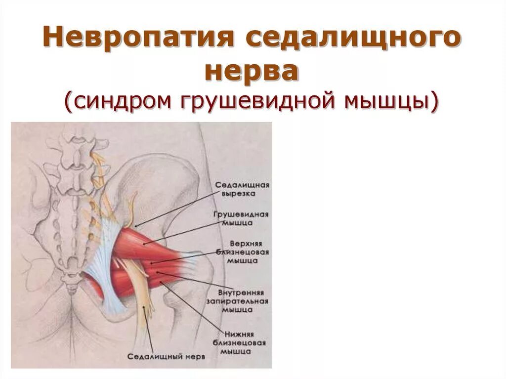 Мышца седалищного нерва. Синдром грушевидной мышцы. Грушевидная мышца и седалищный нерв. Невропатия седалищного нерва. Нерв грушевидной мышцы.