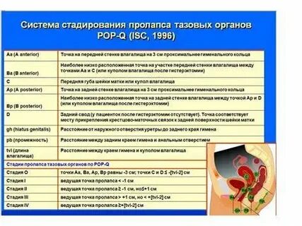 Лечение пролапса тазовых органов у женщин