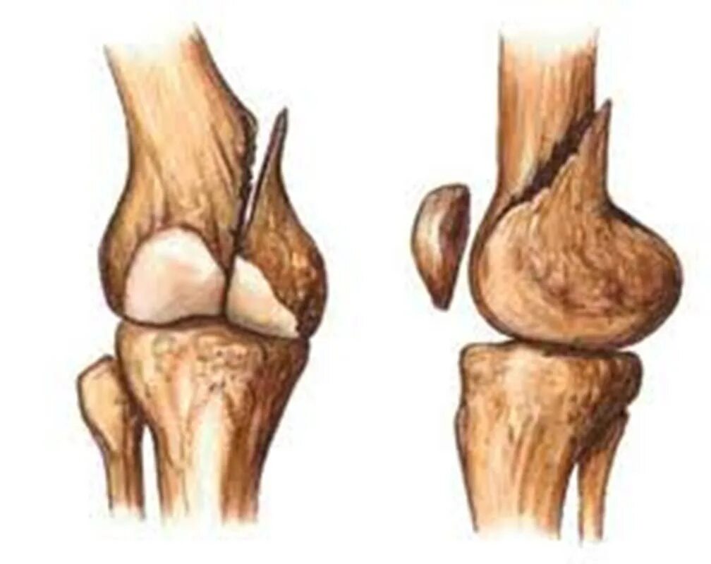 Повреждения мыщелка бедренной кости. Краевой перелом латерального мыщелка бедренной кости. Вдавленный перелом латерального мыщелка бедренной кости. Краевой перелом медиального мыщелка бедренной кости. Краевой перелом мыщелка бедренной кости.