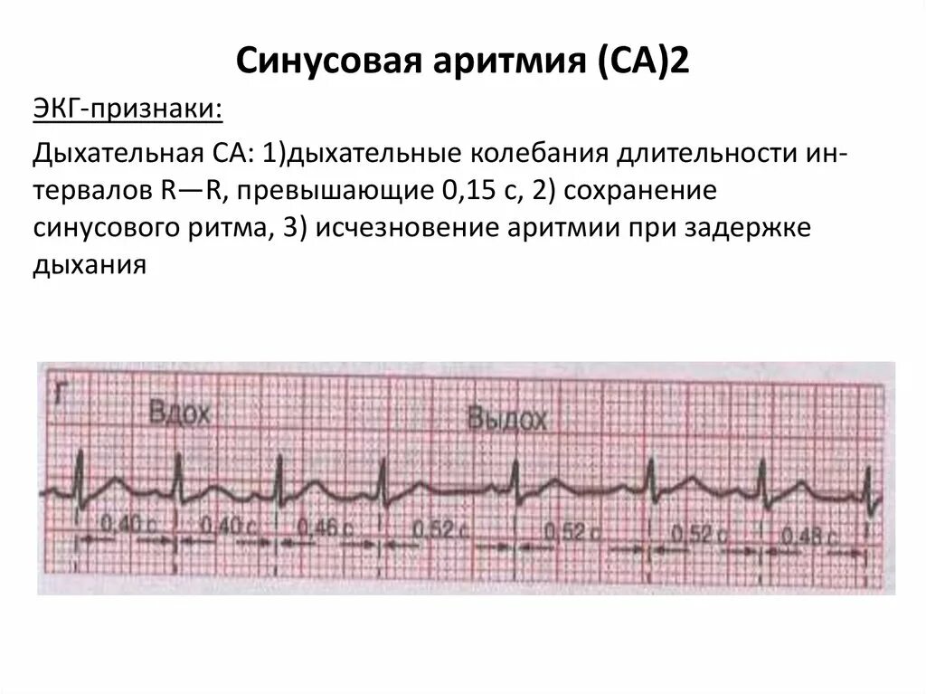Синусовая тахикардия вертикальное. ЭКГ критерии синусовой аритмии. ЭКГ С синусовой аритмией сердца. Синусовая аритмия на ЭКГ. Синусовая аритмия на ЭКГ характеризуется.