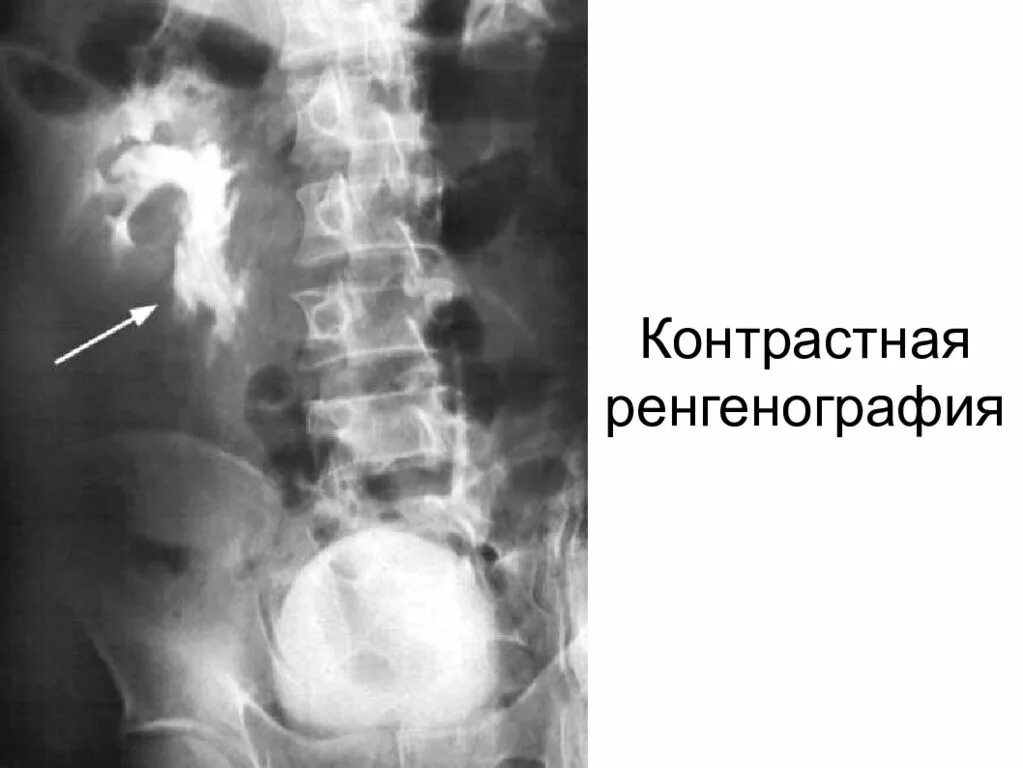 Травма мочеточника. Экскреторная урография при травме почки. Разрыв мочеточника рентген. Экскреторная урография при повреждении почки.