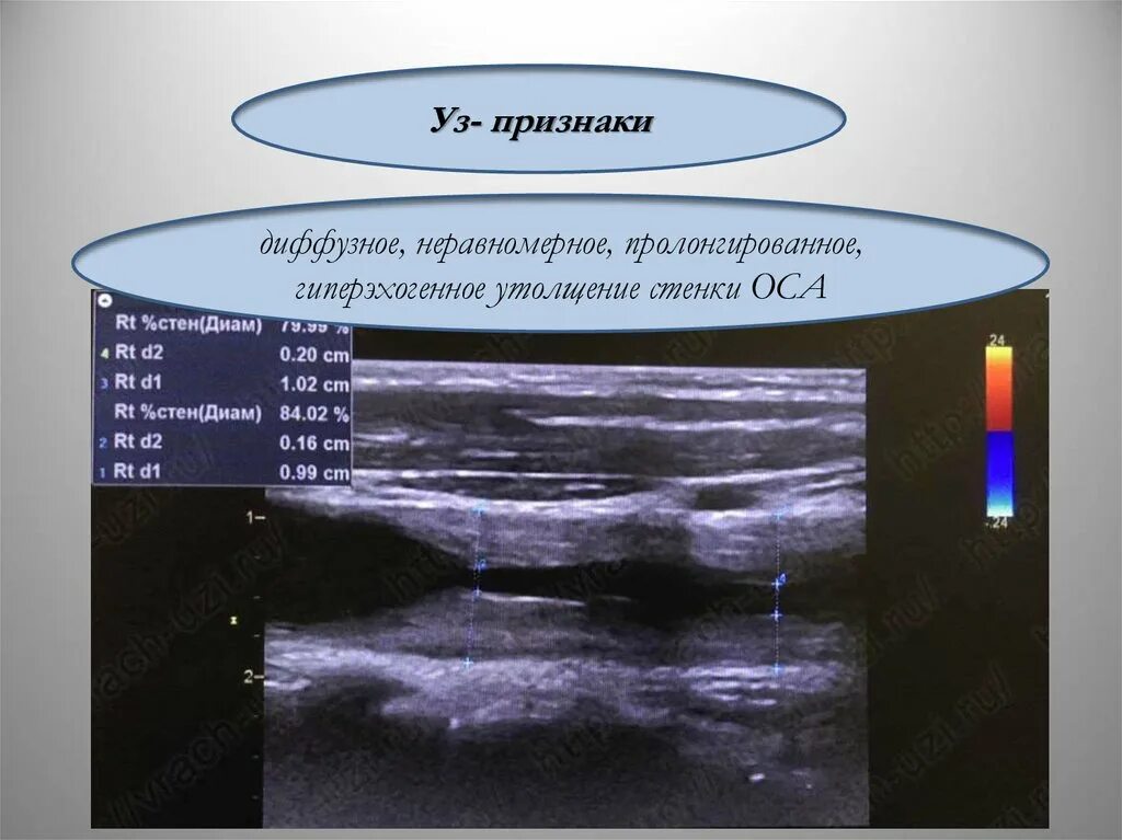 Гиперэхогенные стенки. Стенки Оса. Неравномерная диффузная