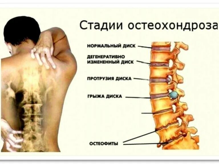 Остеохондроз шейного отдела позвоночника с3-с7. Остеохондроз th5-th8. Остеохондроз 1 позвонка шейного отдела. Остеохондроз спинного отдела позвоночника симптомы.