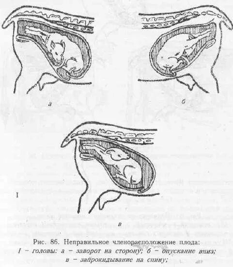 нагрузка на поясницу при наклоне. неправильное расположения. неправильное положение плода. неправильное положение плода в 1 позиции. неправильное расположения.