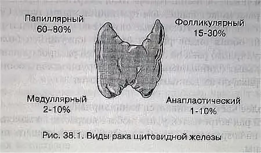 Медуллярная опухоль щитовидной железы. Медуллярная карцинома щитовидной железы. Rak Shitovidnoy jelezi. Фолликулярная карцинома щитовидной железы.