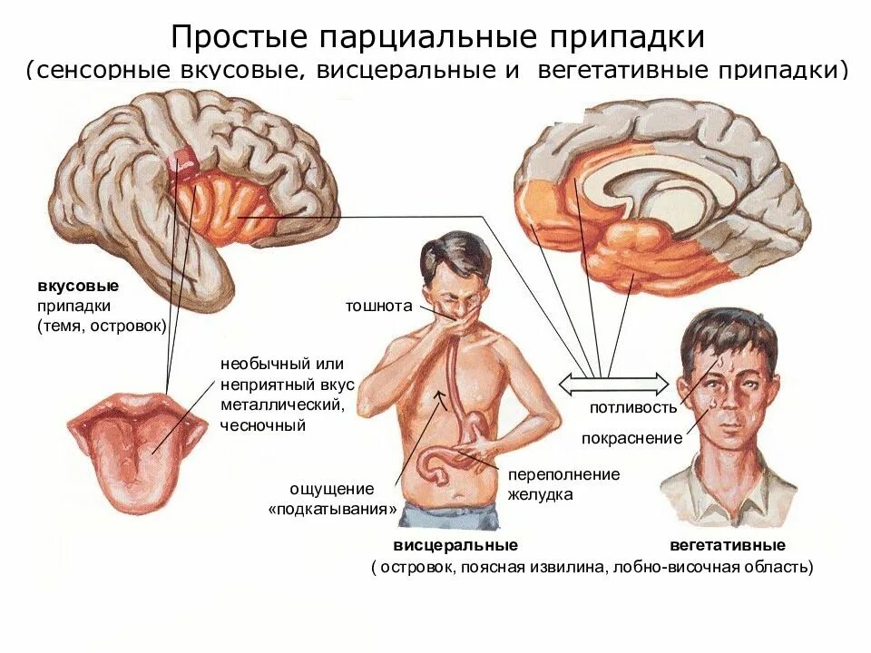 Эпилепсия нервной системы. Парциальные припадки эпилепсии симптомы. Простые парциальные припадки эпилепсии симптомы. Простые парциальные приступы. Простые парциальные припадки сенсорные.
