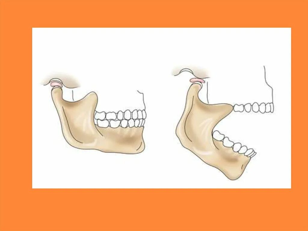 Подвывих сустава челюсти. Вывих сустава нижней челюсти. Вывих височно-нижнечелюстного сочленения (вывих нижней челюсти). Мыщелок челюсти