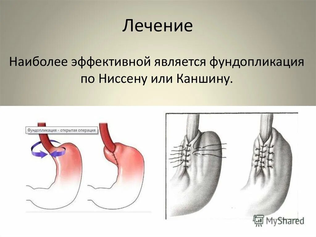 Развитие пищевода