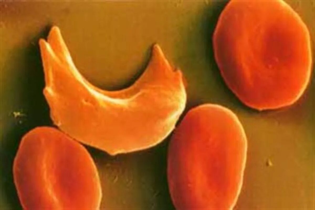 Серповидно клеточная анемия признаки. Серповидноклеточная анемия. Серповидно-клеточная анемия (s-гемоглобинопатия). Талассемия и серповидноклеточная анемия. Серповидно клеточная анемия, талассемия.