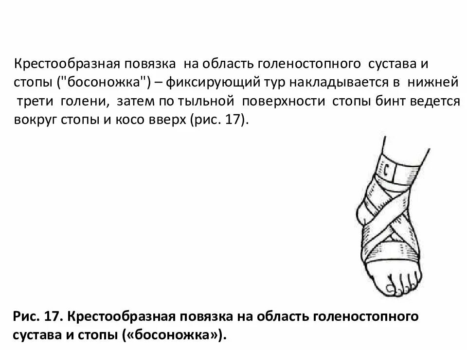 Техника наложения крестообразной повязки на голеностопный сустав. Повязка на голеностопный сустав десмургия. Восьмиобразная повязка на голеностопный сустав техника. Наложение фиксирующей повязки на голеностопный сустав. Какая повязка при повреждении голеностопного сустава