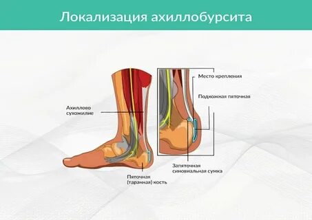 Ахиллово сухожилие болит при ходьбе