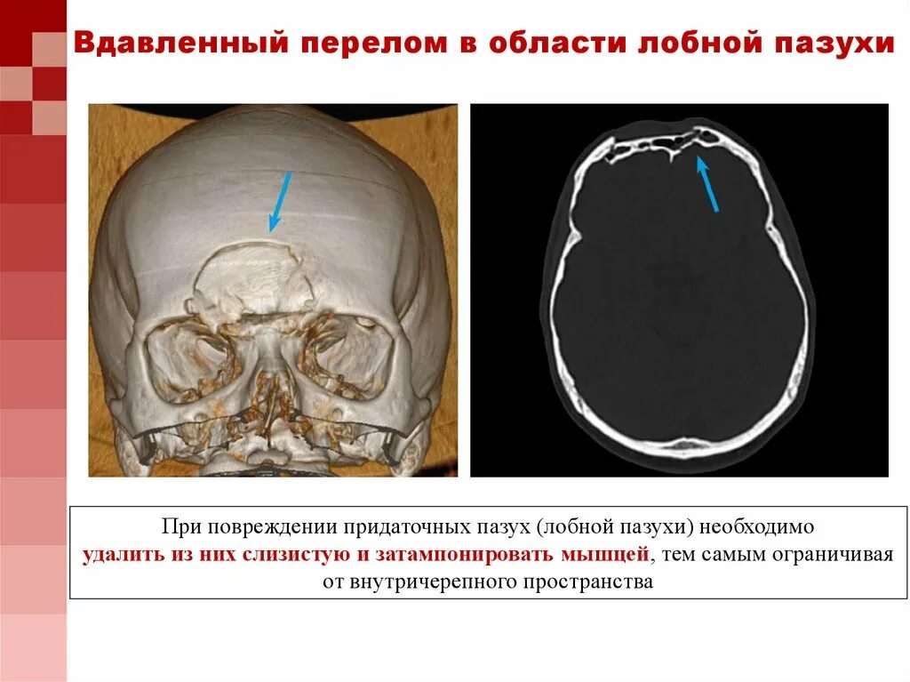 Для перелома основания черепа характерно. Перелом свода основания черепа. Перелом костей основания черепа. Перелом основания свода черепа последствия. При переломе основания черепа.