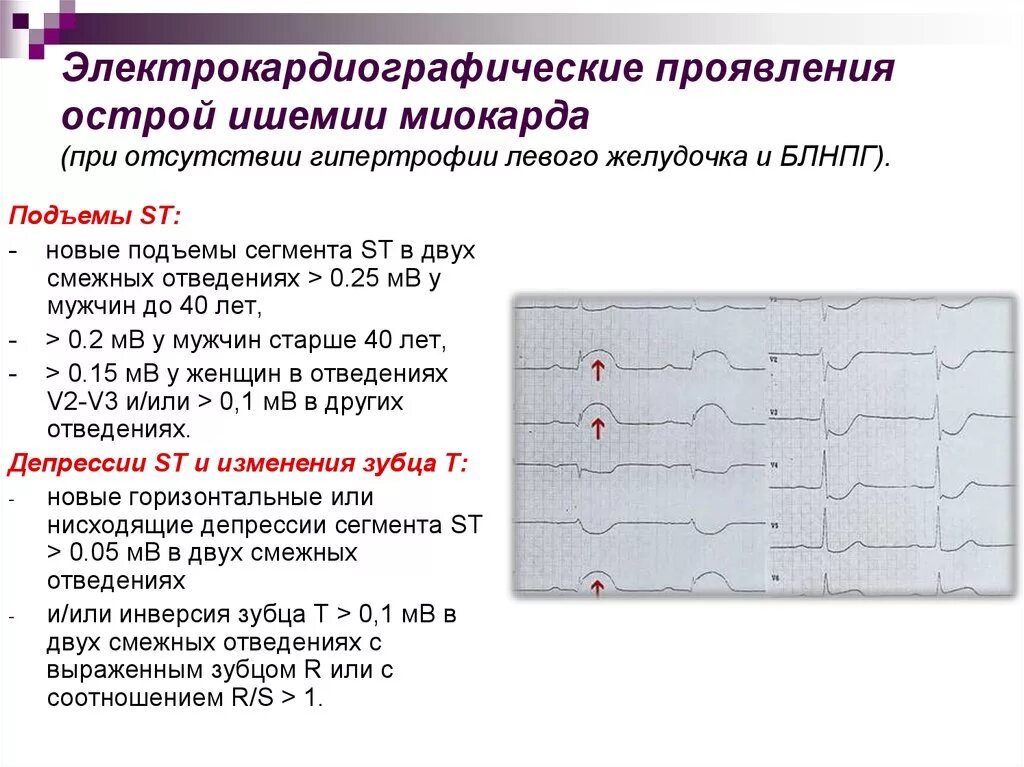 Критерии ишемии. Ишемия на ЭКГ. ЭКГ острый инфаркт миокарда с подъемом St. Разрыв миокарда левого желудочка ЭКГ. ЭКГ критерии инфаркта миокарда.