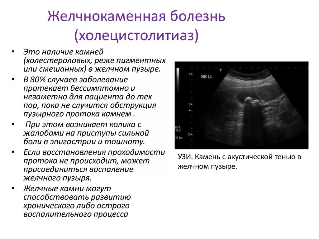 Сморщенный желчный пузырь. Желчнокаменная болезнь лучевая диагностика. Желчекаменная болезнь рентгенологические симптомы. УЗИ желчного пузыря при ЖКБ. УЗИ желчного пузыря желчнокаменная болезнь.