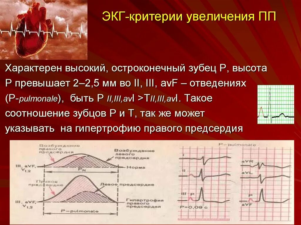 Для гипертрофии правого предсердия характерен зубец р. Высокий остроконечный зубец р во II, III, AVF отведениях. Зубец р на ЭКГ. Высокий остроконечный зубец р. Отведение v1 на экг