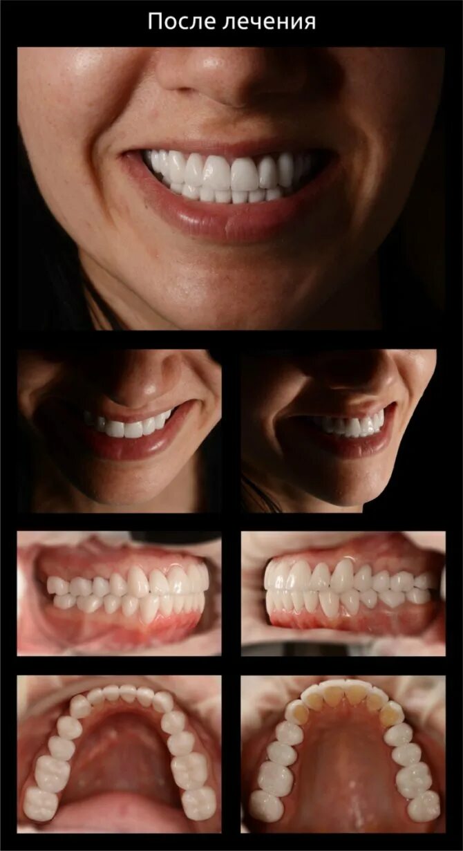 Сколько по времени делают зубы. Фотокомпозитные виниры. Керамокомпозитные виниры.
