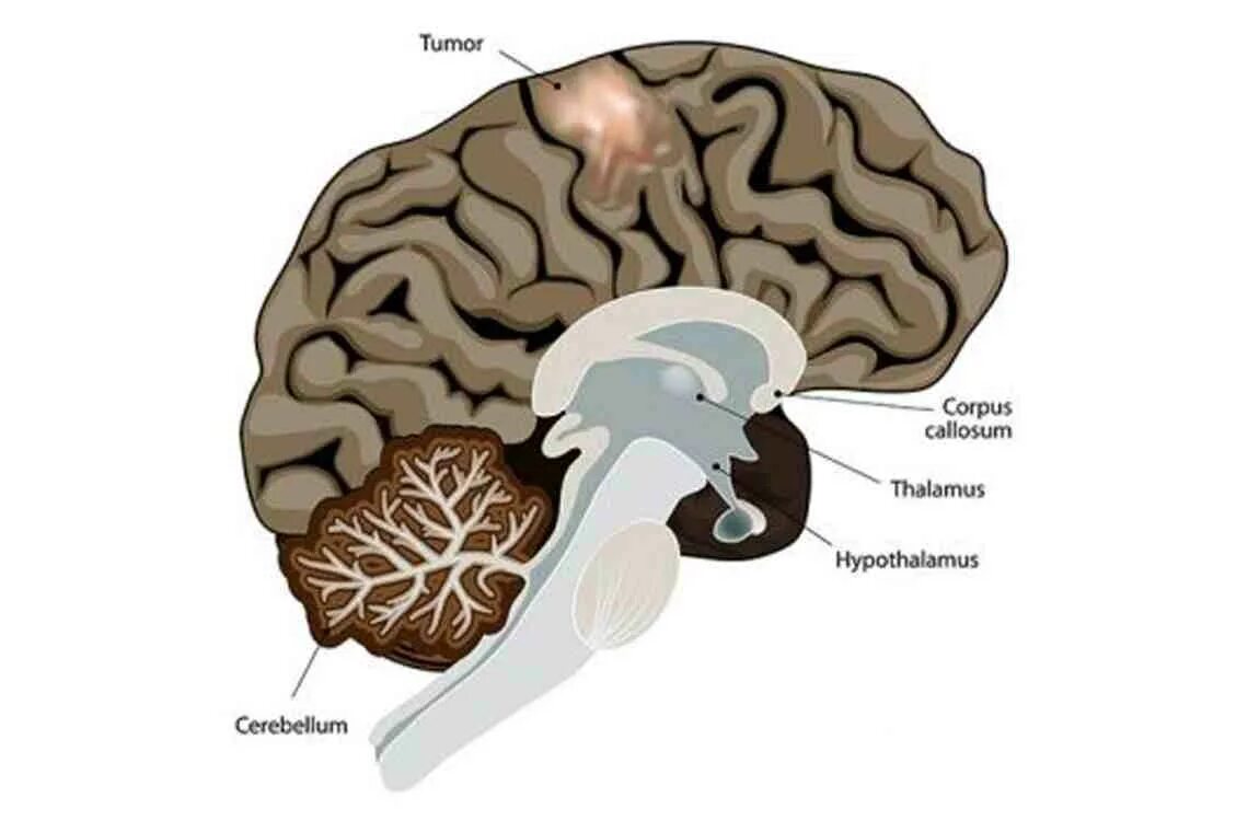 Рак ствола головного мозга. Диффузная глиома ствола головного. Диффузная глиома ствола головного мозга у детей. Диффузная опухоль ствола головного мозга.